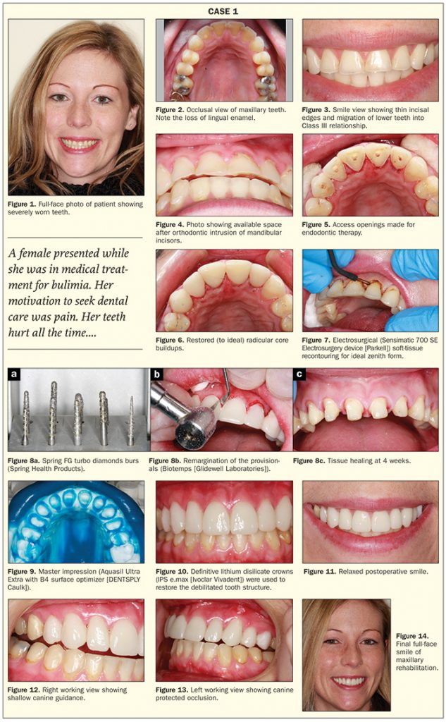 Bulimia: Complex Etiology, Challenging Treatment - Dentistry Today