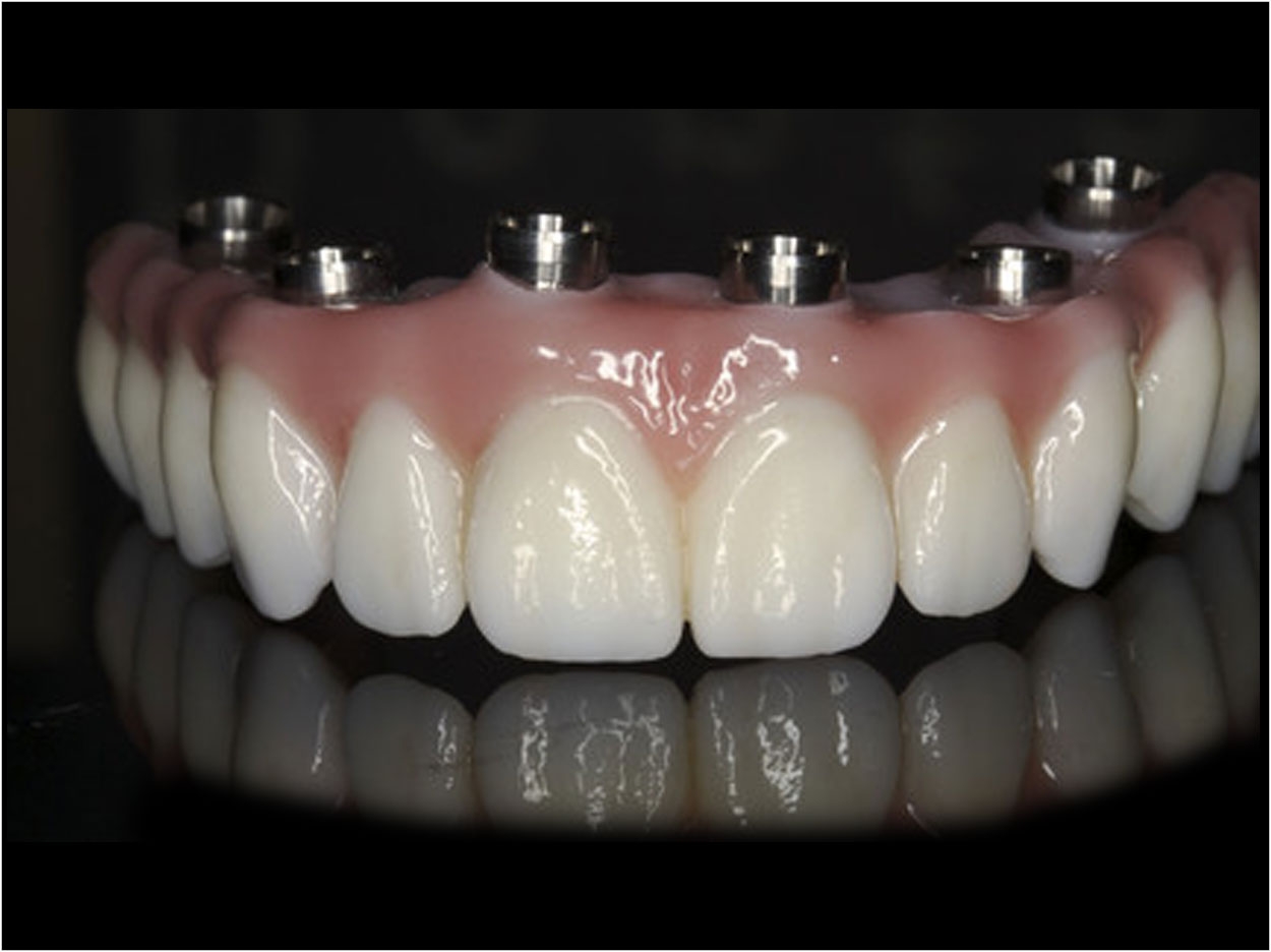 Future Trends In Implant Dentistry - Dentistry Today