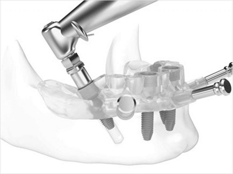 Guided Implant Surgical Applications Dentistry Today 3186