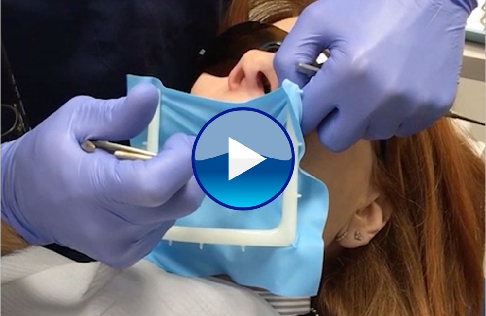 Simple Techniques for Dental Dam Applications Dentistry Today