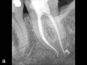 Single-File Shaping Technique: Achieving a Gold Medal Result ...