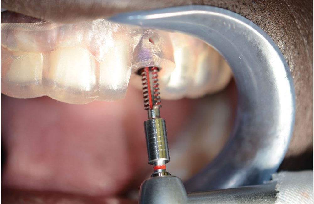 The Implant Market Will Grow By 9.7% Through 2020 - Dentistry Today