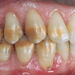 Uveneer: Simplifying Artistic Direct Composite Veneering - Dentistry Today