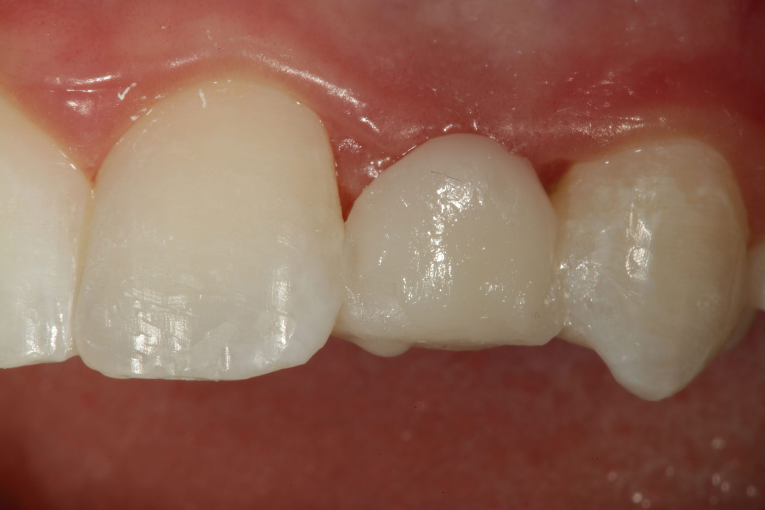 Uveneer: Simplifying Artistic Direct Composite Veneering - Dentistry Today