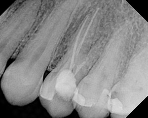 Creating Well-Obturated Canals: The Use of Warm Vertical Condensation ...