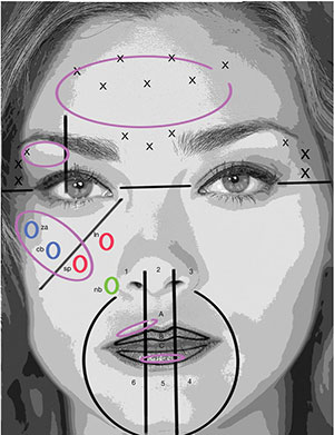 Platelet-Rich Growth Factor for Lip and Perioral Rejuvenation: A