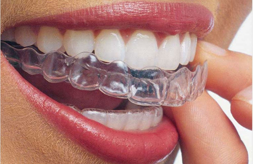 Кап для зубов фото Invisible Braces to See 12.16% Growth Through 2021 - Dentistry Today