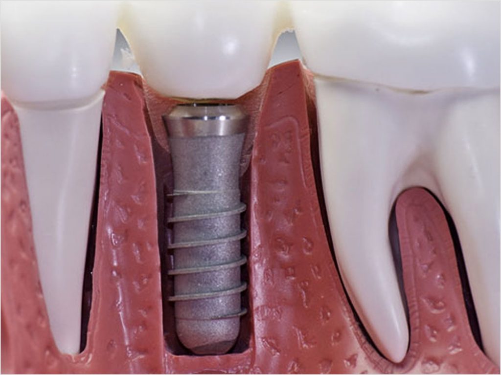 Dental Implants Prosthetic Options Dentistry Today 7397