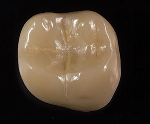 Single-visit Chairside Zirconia - Dentistry Today