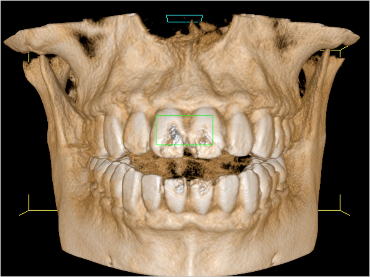 CBCT Planning for Implant Dentistry Dentistry Today