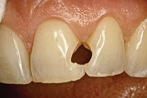 Successfully Restoring Class III Composites The Challenge Of Deep Subgingival Margins