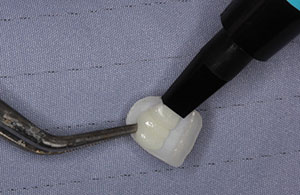 Minimally Invasive Preps for Thin Porcelain Veneers - Dentistry Today