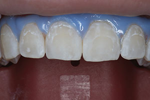 Treating Post-Orthodontic White Spots: A Conservative Resin ...