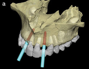 Should General Practitioners Place Implants? - Dentistry Today