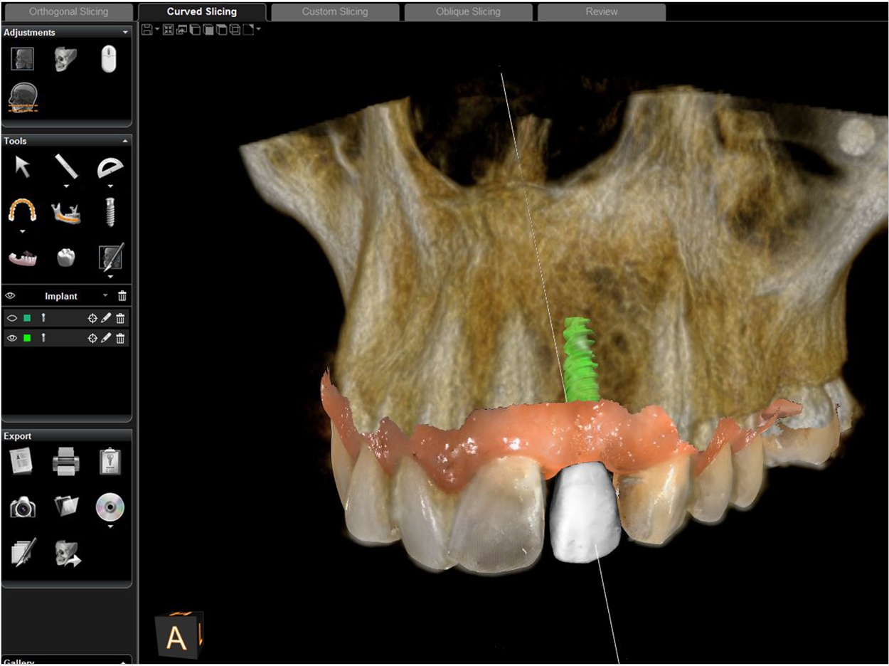 Digital Workflow Improves Implant Predictability - Dentistry Today