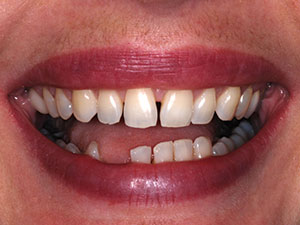 Aesthetics and Strength With One Restorative Material - Dentistry Today