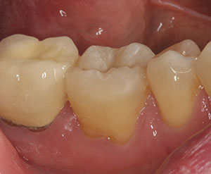 A One-Visit Option: An Alternative to Traditional Ceramic Restorations - Dentistry  Today