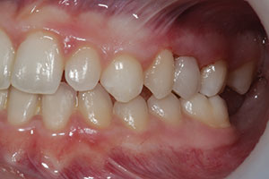 Uveneer: Simplifying Artistic Direct Composite Veneering - Dentistry Today