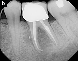 Advances in Biomechanical Preparation - Dentistry Today