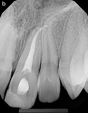 Advances in Biomechanical Preparation - Dentistry Today