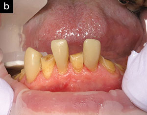 Minimally Invasive Bio-Rejuvenation Dentistry: A Conservative Approach ...