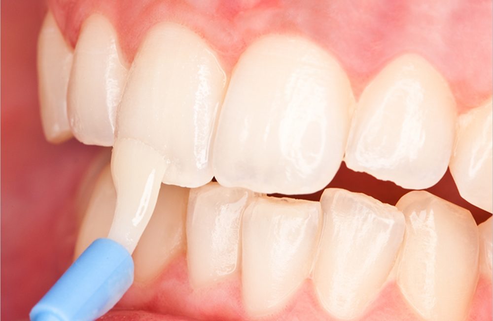 Fluoride Varnish as Effective as Sealants in Preventing Decay