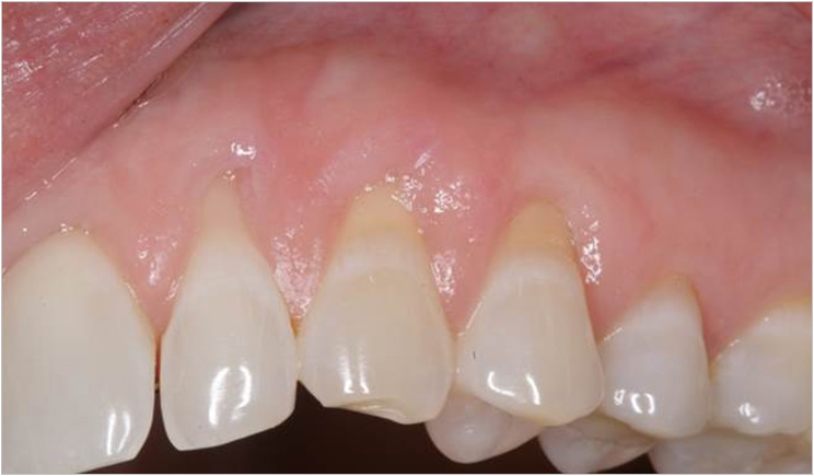 Alloderm Reverse Tunneling: A Novel Approach For Treating Gingival ...