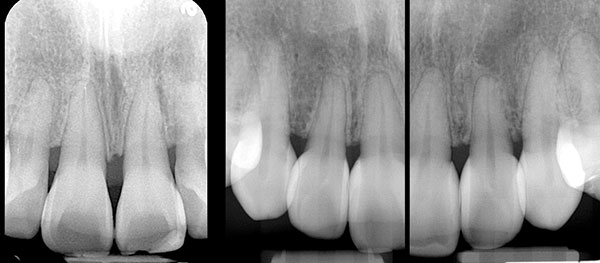 Full-Mouth Black Triangle Treatment Protocol - Dentistry Today