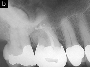 Endodontic Controversies: Structural and Technological Insights ...