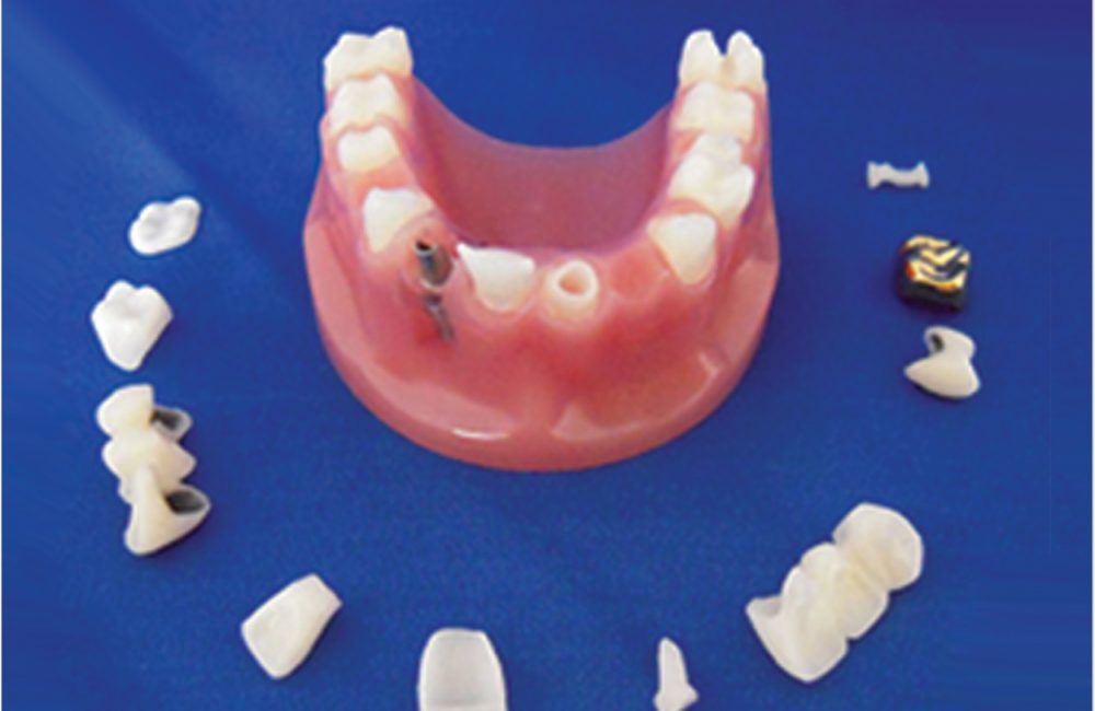 Dental Crowns & Bridges  Clay & Associates DDS, PLC