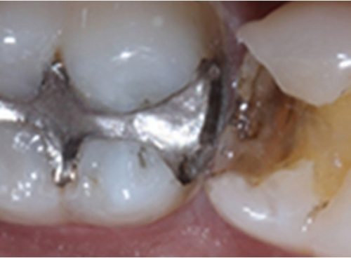 5 Lessons You Can Learn From Bing About tooth prosthesis