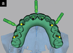 CBCT Enhances Facially Driven Digital Implant Design - Dentistry Today