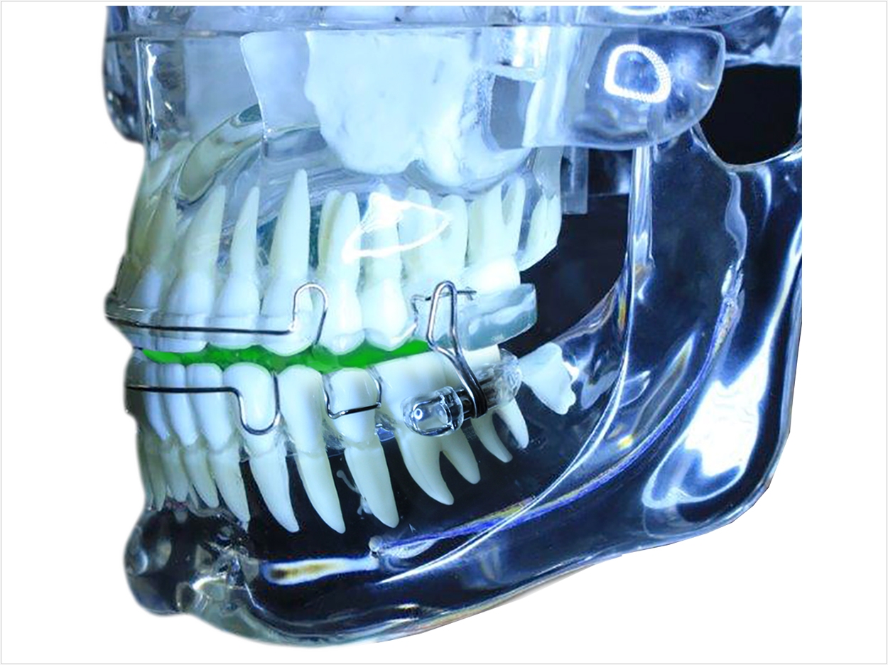 Dental Appliances for Sleep Apnea