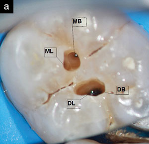 A Revolutionary Protocol for Endodontic Access - Dentistry Today