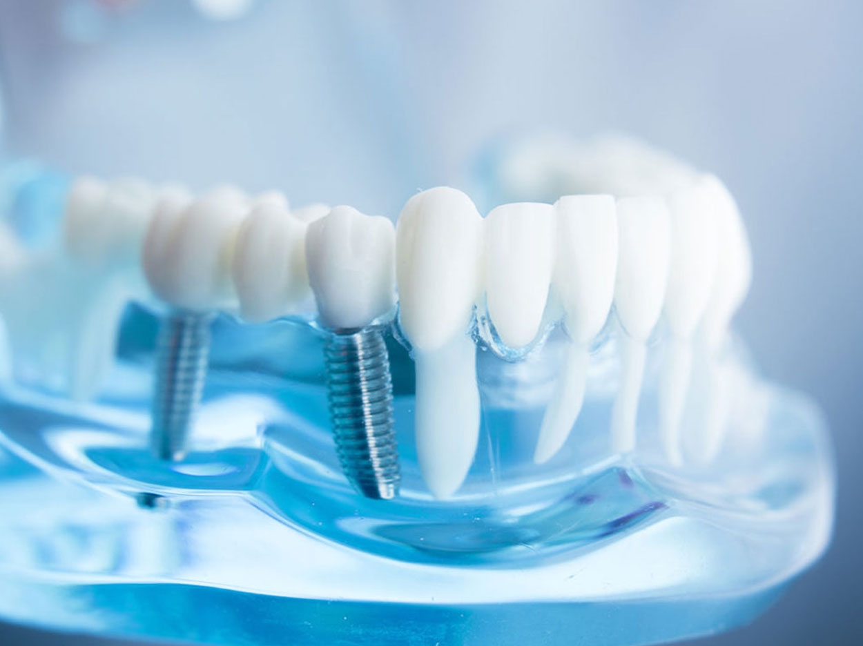 The Dental Implant Practice - Dentistry Today