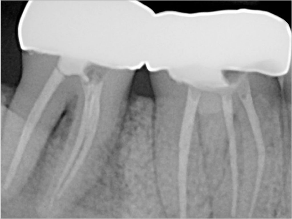 Vertical Root Fractures Occur More Frequently When A Post Is Present Dentistry Today