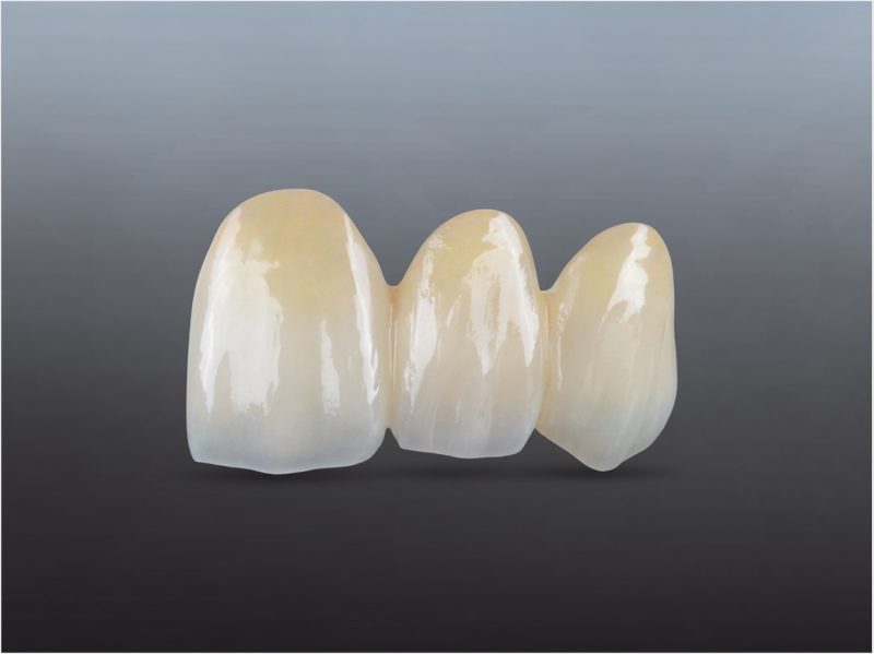 Zirconia Exhibits Natural Vitality and Enhanced Shade Consistency ...