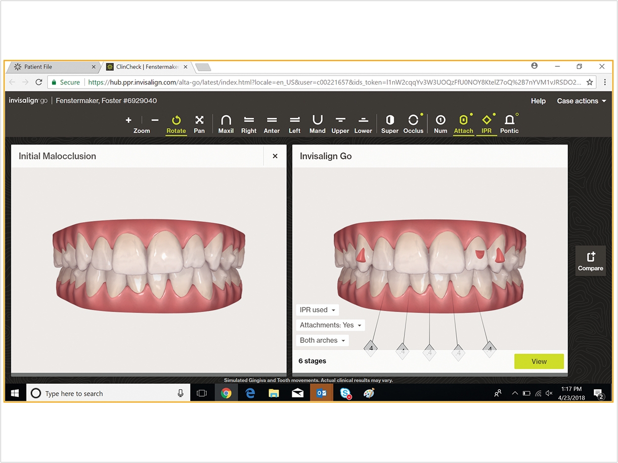Customizable Retainers Provide Additional Support – Dentistry Today