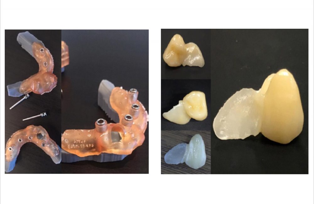 Surgical Guides for Implant Dentistry