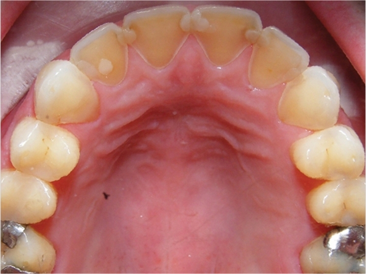 Study To Explore How Well Dentists Identify Erosive Tooth Wear ...