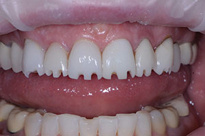 Replacing Existing Restorations: A Treatment Planning Challenge ...