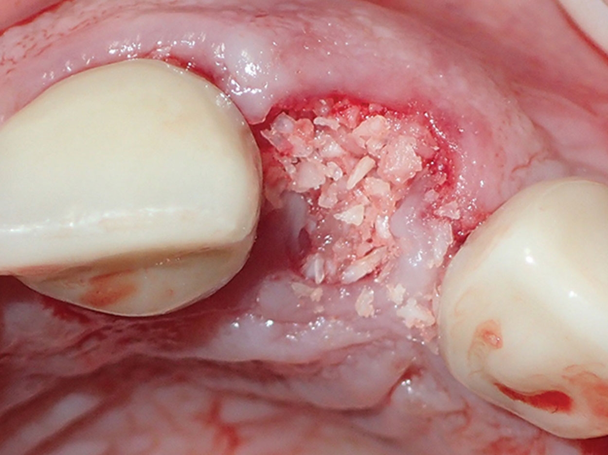Bone Grafting for Implant Dentistry - Dentistry Today