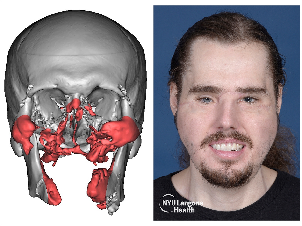 Face Transplant Rebuilds Jaw, Teeth, and Gums Dentistry Today