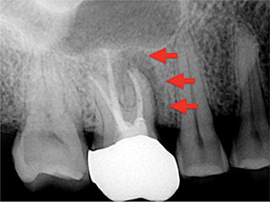 A More Precise Way to Re-treat Root Canals - Dentistry Today