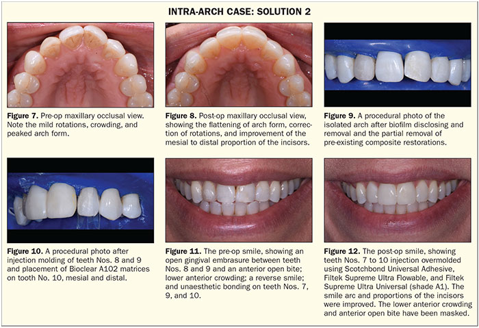 Restorative Orthodontics With Injection Overmolding Intra Arch And