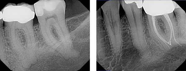 Internal Routing: A Paradigm Shift in Endodontic Instrumentation ...