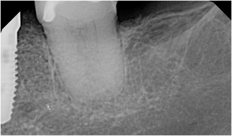 A Short Case Study: Hypertaurodont! - Dentistry Today