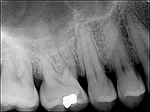 Better and Faster Root Canal Treatments: A Synopsis of the Latest High ...