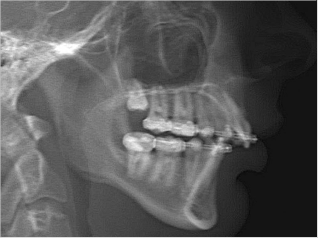 Protocol Addresses Jaw Deformities Caused By Juvenile Idiopathic 