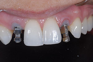 Implants in the Aesthetic Zone: Simplifying Aesthetic Challenges ...